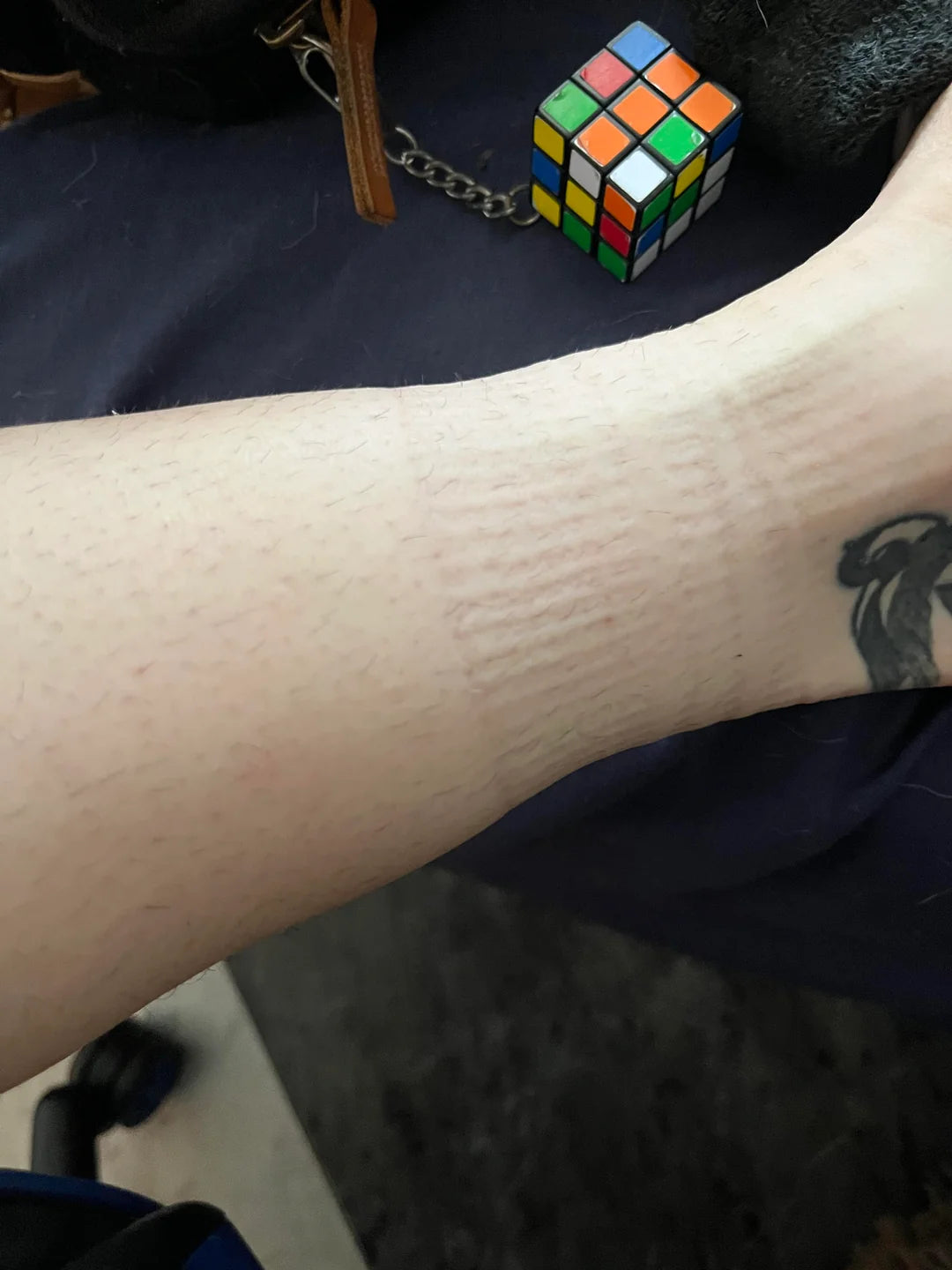 Anybody experience this - sock marks on legs