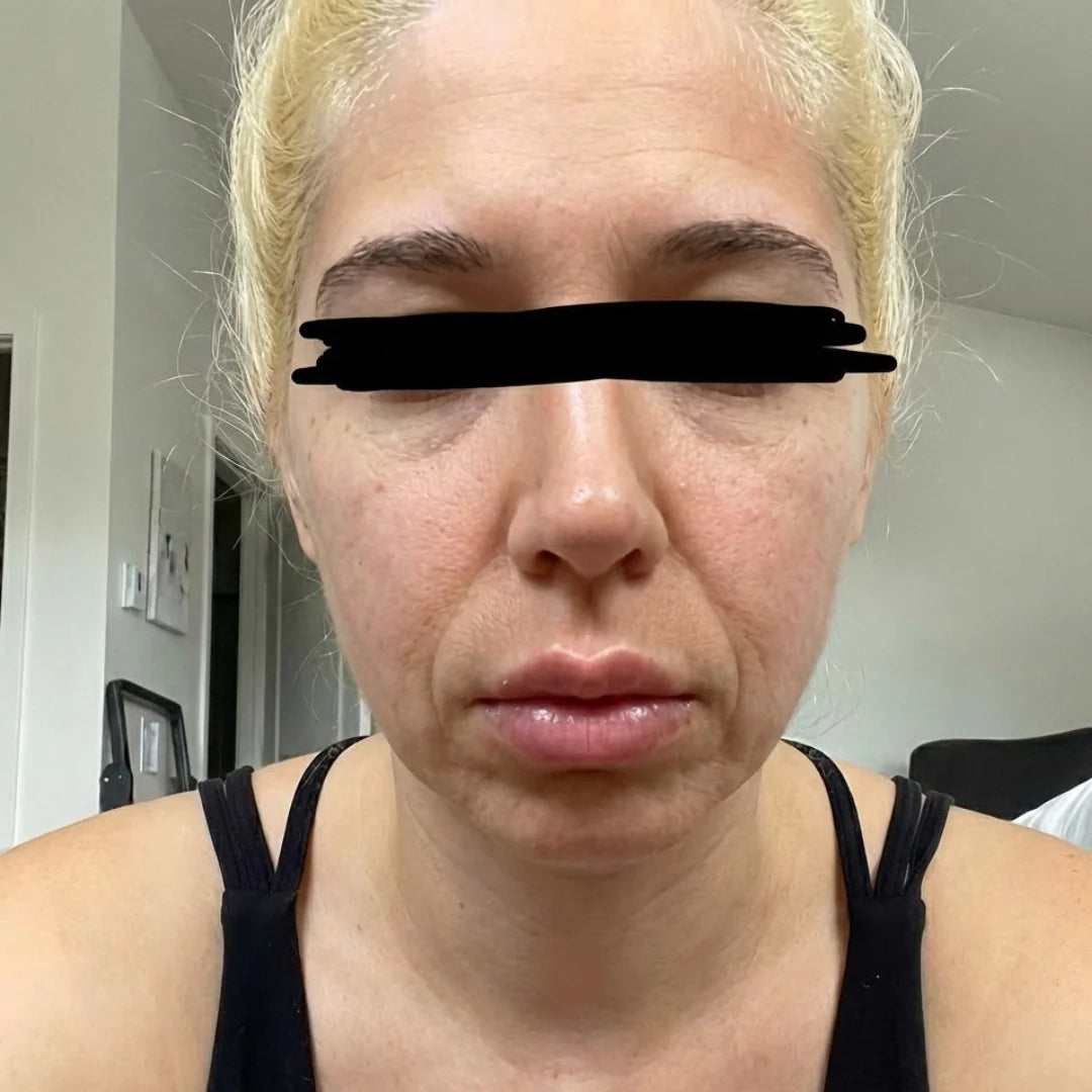 Woman with facial puffiness from fluid retention